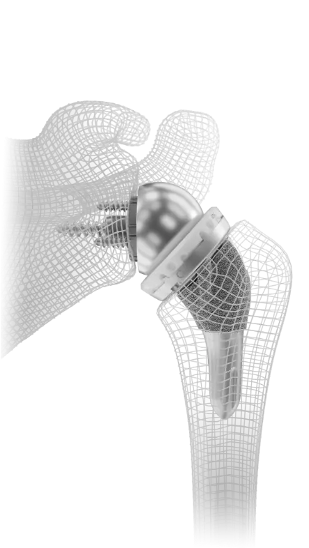 InSet® reverse shoulder replacement