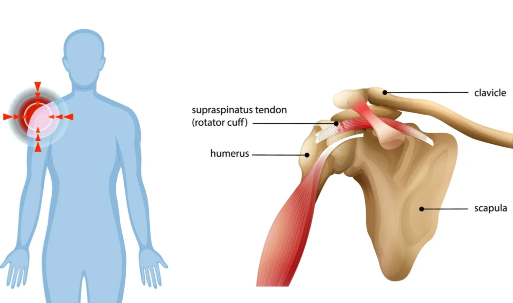 A diagram of a rotator cuff tear