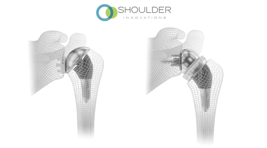 A comparison of a total shoulder implant and a reverse shoulder implant