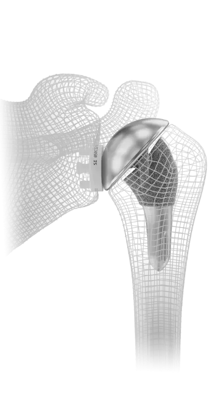 InSet® total shoulder replacement
