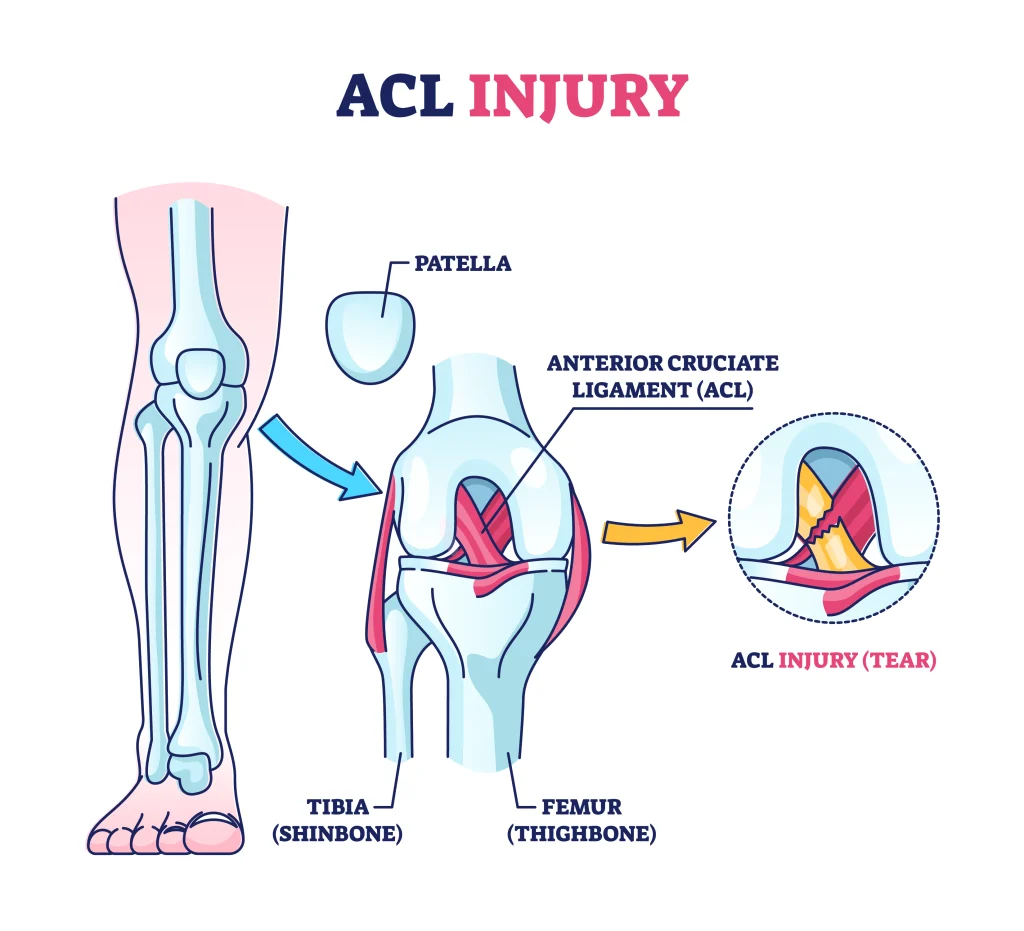 ACL tear diagram. 