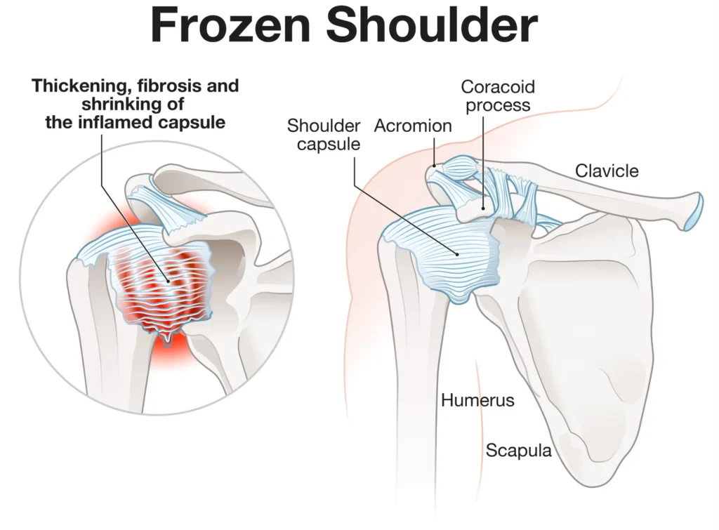 Frozen shoulder diagram.