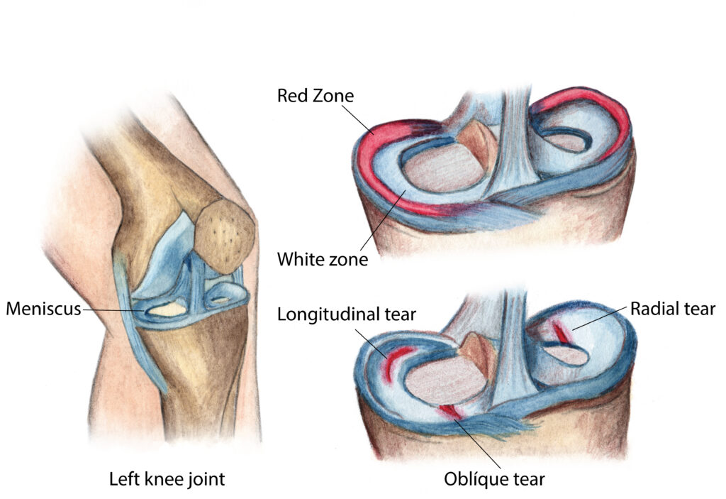 Diagram of meniscus zones and tear types