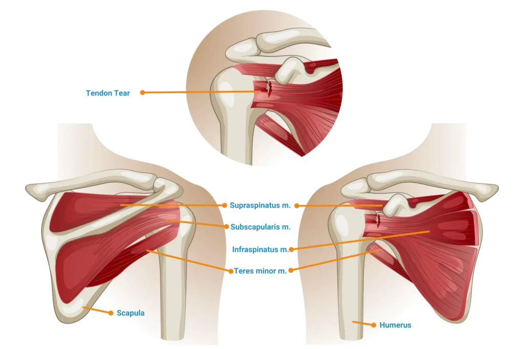 Anatomical illustration of a rotator cuff tendon tear, with the supraspinatus, subscapularis, infraspinatus and teres minor muscles labeled