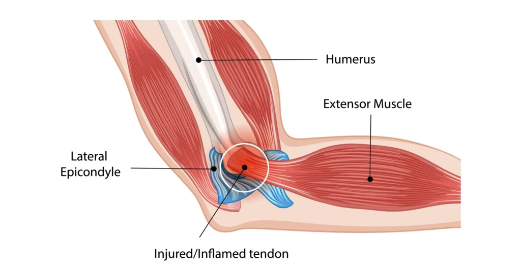 Diagram of tennis elbow showing the extensor muscle and inflamed tendon where it attaches to the lateral epicondyle of the humerus