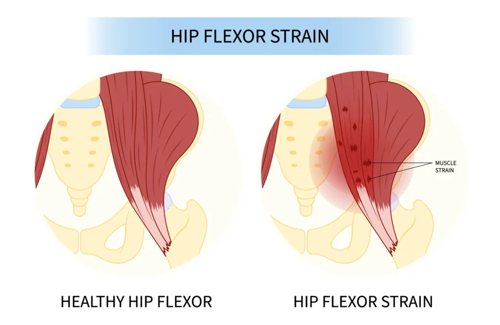 Illustration comparing a healthy hip flexor muscle with a hip flexor strain