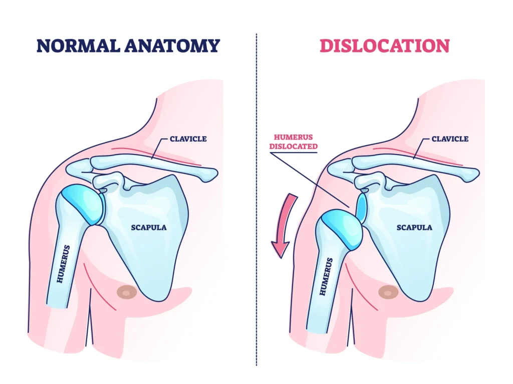 Diagram comparing normal shoulder anatomy with a dislocated shoulder